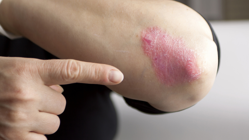 Psoriasis är en systemisk sjukdom med en mängd olika symptom och individuella varianter. Varje patient är liksom unik.  Foto: Shutterstock